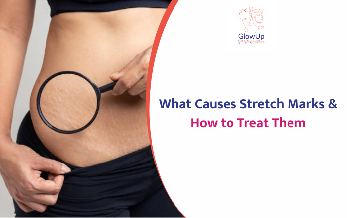What Causes Stretch Marks & Can You Remove Them?